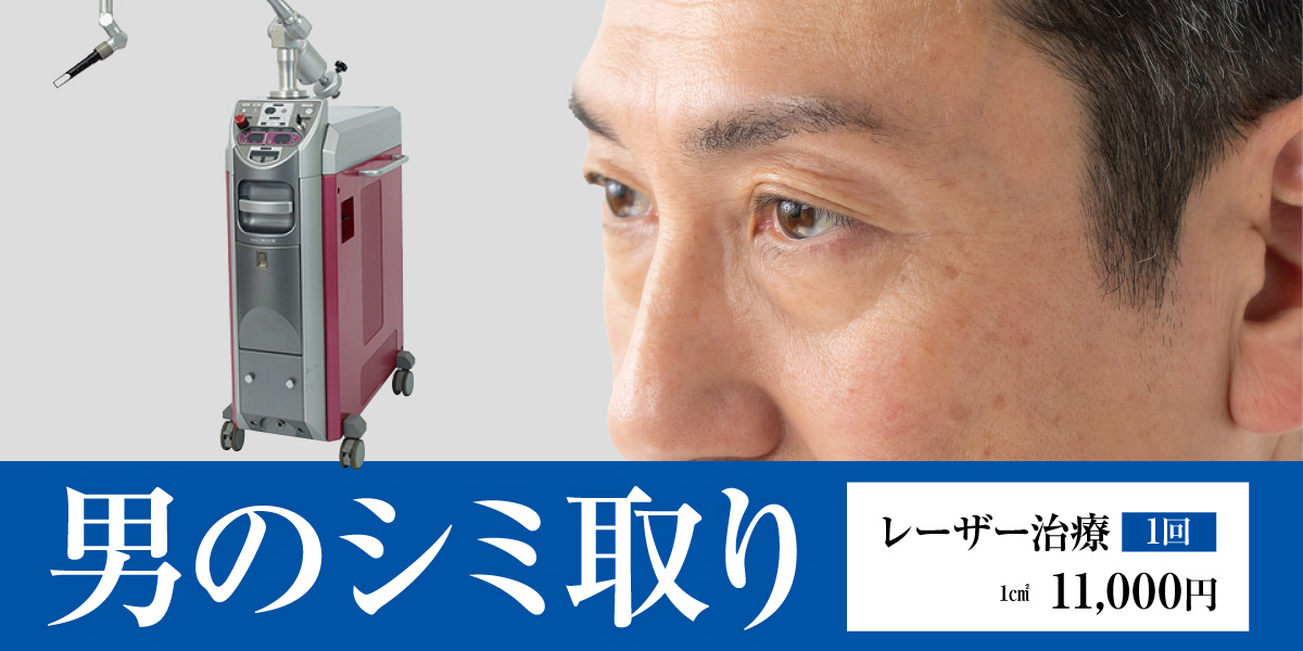 男のシミ取り